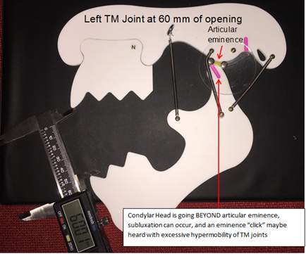 https://www.treatingtmj.com/wp-content/uploads/tmj-hypermobility3.png